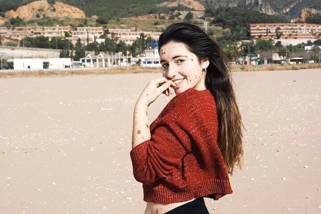 Selama hidupnya, Alba Parejo sudah kenyang menerima komentar jahat terkait kondisi fisiknya. Remaja ini bahkan kerap dijuluki dalmatian hingga alien karena punya 500 tanda lahir di tubuhnya. Foto: Instagram @albaparejo_