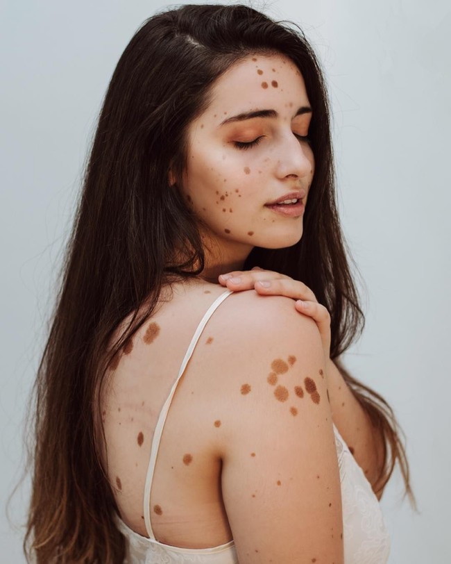 Cacian tersebut tentu sempat membuatnya minder dengan penampilan. Untungnya, kini Alba tidak lagi merasa demikian bahkan sudah percaya diri untuk jadi model. Foto: Instagram @albaparejo_