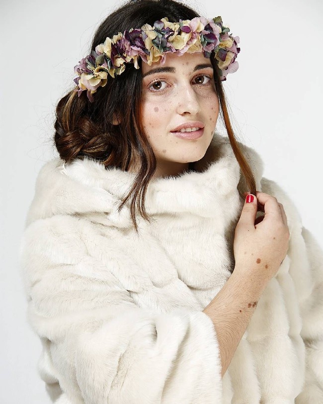 Aku sekarang menyadarai bahwa kulitku cantik, spesial, dan unik. Aku sudah jadi model pusat perbelanjaan Anec Blau dan model untuk pekerjaan para seniman, ungkap wanita asal Spanyol ini dengan bangga. Foto: Instagram @albaparejo_