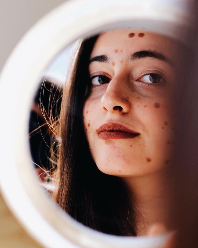 Alba memang mengidap kondisi congenital melanocytic nevus yang membuat tubuhnya dipenuhi noda-noda gelap. Ia pun sempat menjalani 30 operasi untuk menghilangkannya tapi telah berhenti karena trauma. Foto: Instagram @albaparejo_