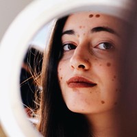 Alba memang mengidap kondisi congenital melanocytic nevus yang membuat tubuhnya dipenuhi noda-noda gelap. Ia pun sempat menjalani 30 operasi untuk menghilangkannya tapi telah berhenti karena trauma. Foto: Instagram @albaparejo_