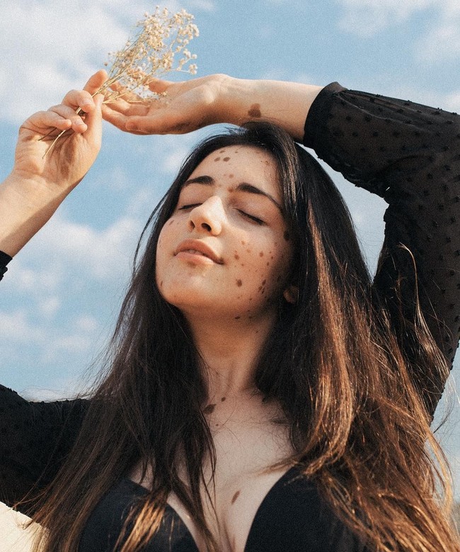 Aku memilih untuk lebih terbuka mengenai kondisiku dan mengunggah foto kulitku di Twitter, berpikir itu hanya akan dilihat teman-temanku tapi aku salah. Aku dihubungi orang-orang dari seluruh dunia, berkata betapa aku menginspirasi dan itu menolongku untuk mencintai diriku sendiri dan kulitku, tambahnya. Foto: Instagram @albaparejo_