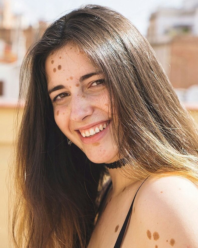 Sering dipandangi bahkan ditertawakan, remaja 17 tahun ini sempat merasa dirinya seperti monster. Tapi setelah bisa menerima kondisi tersebut, ia pun lebih percaya diri dengan penampilan. Bahkan Alba berani mengunggah foto tubuhnya yang penuh tanda lahir di media sosialnya. Foto: Instagram @albaparejo_