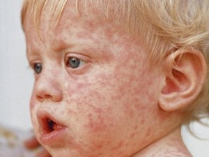 UNICEF: Jutaan Anak di Dunia Belum Divaksin Campak, Sebabkan Wabah