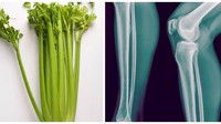 Tulang manusia ternyata hampir mirip dengan batang seledri. Foto hasil sinar X-ray yang menunjukkan tulang manusia ini jadi buktinya. Foto: Womans Day