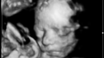 Ini foto USG Baby Luyendyk yang sudah jadi selebgram sejak di kandungan. (Foto: Instagram @laureneburnham)