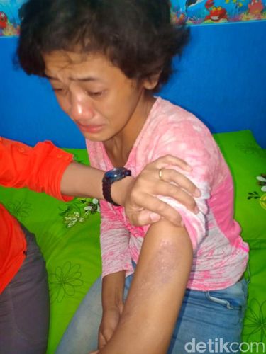 Santi menunjukkan bekas luka akibat disiram air panas