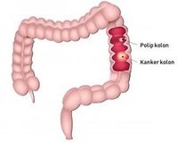 Langkah Tepat Atasi Malnutrisi pada Kanker Kolorektal