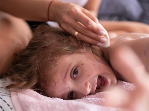 Mengenal Penyakit Herpes: Gejala, Penyebab, Jenis, dan Cara Mengobati