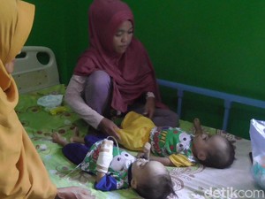 Bayi Kembar di Polman Idap Gizi Buruk, Ortu Kesulitan Biayai Perawatan