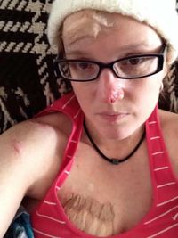 Lisa Pace melawan kanker kulit.