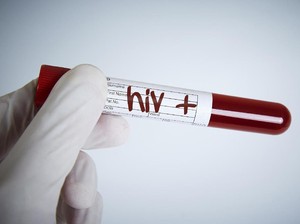 Heboh Pasien Esperanza Sembuh dari HIV Tanpa Obat, Bagaimana Penjelasannya?