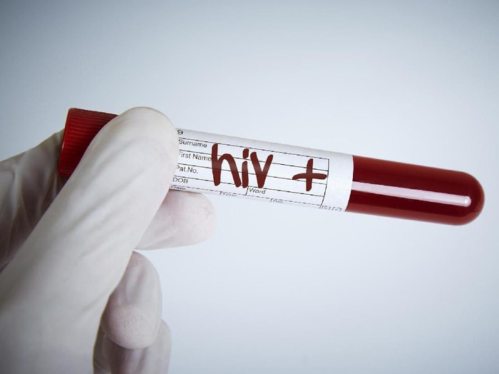 Ilustrasi HIV AIDS (Foto: iStock)