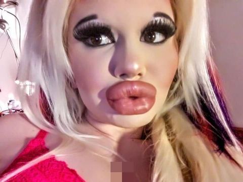 Bibir Jumbo Mirip Monster, Wanita Ini Obsesi Punya Bibir Terbesar di Dunia
