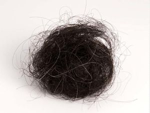Ajaib! Gumpalan Rambut Seberat 2 Kg Diangkat dari Perut Remaja Ini