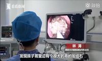 Punya Hobi Makan Aneh, Dokter Temukan Bola Rambut di Perut Anak Ini