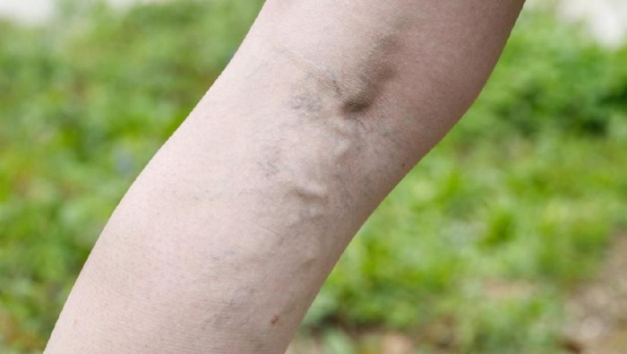 Varicose veins in pregnant women. Woman sits on bed and points her finger at swollen veins.