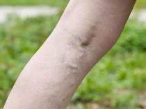 Bisakah Varises Diobati dengan Jahe? Simak Faktanya!