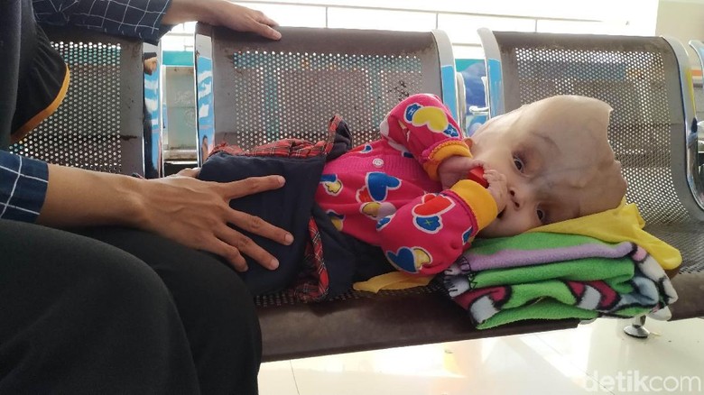 Dipantau RSHS, Bayi Tanpa Tempurung Kepala Kontrol Sebulan Sekali Dipantau RSHS, Bayi Tanpa Tempurung Kepala Kontrol Sebulan Sekali