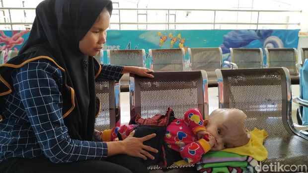 Bayi Tanpa Tempurung Kepala Rutin Kontrol ke RSHS Bandung