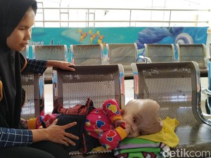Malangnya Bayi Saira, Penderita Hidrosefalus Tanpa Tempurung Kepala