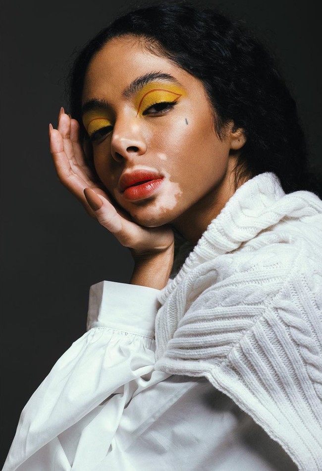 Shahad Salman tidak lagi malu menampilkan kondisi kulitnya yang vitiligo. Vitiligo adalah kelainan kulit yang menyebabkan depigmentasi tak merata sehingga tampak belang. Kondisi ini tidak menular. Foto: Instagram @5sunshine1, Vogue Arabia