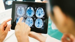 Cegah Penyakit Stroke dengan Brain Check Up, Segini Biayanya