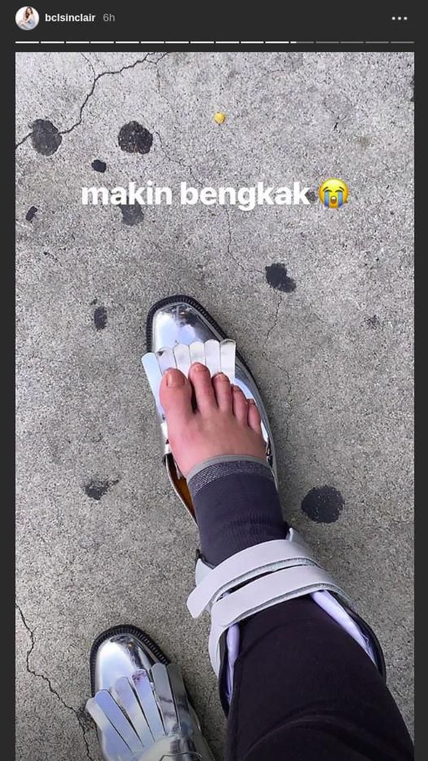 Jatuh di Los Angeles, Bunga Citra Lestari Harus Jalan Pakai Tongkat