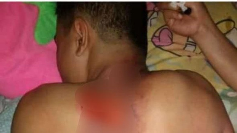 Viral Siswa Disiram Air Keras di Pacitan, Polisi Tunggu Laporan Viral Siswa Disiram Air Keras di Pacitan, Polisi Tunggu Laporan