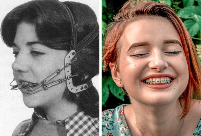 Bentuk kawat gigi zaman dulu memiliki pengait yang panjang hingga ke belakang kepala. Namun sekarang, behel cukup menempel di gigi saja dan sudah menjadi statement fashion tersendiri. (Foto: Istimewa)