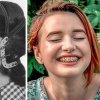 Bentuk kawat gigi zaman dulu memiliki pengait yang panjang hingga ke belakang kepala. Namun sekarang, behel cukup menempel di gigi saja dan sudah menjadi statement fashion tersendiri. (Foto: Istimewa)