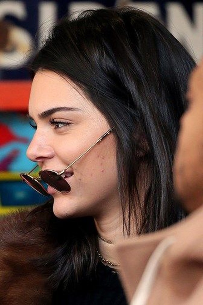 Tidak selamanya kulit Kendall Jenner berada dalam kondisi prima dan mulus. Ada kalanya, model 23 tahun ini mengalami jerawat parah yang memenuhi wajahnya. Foto: istimewa