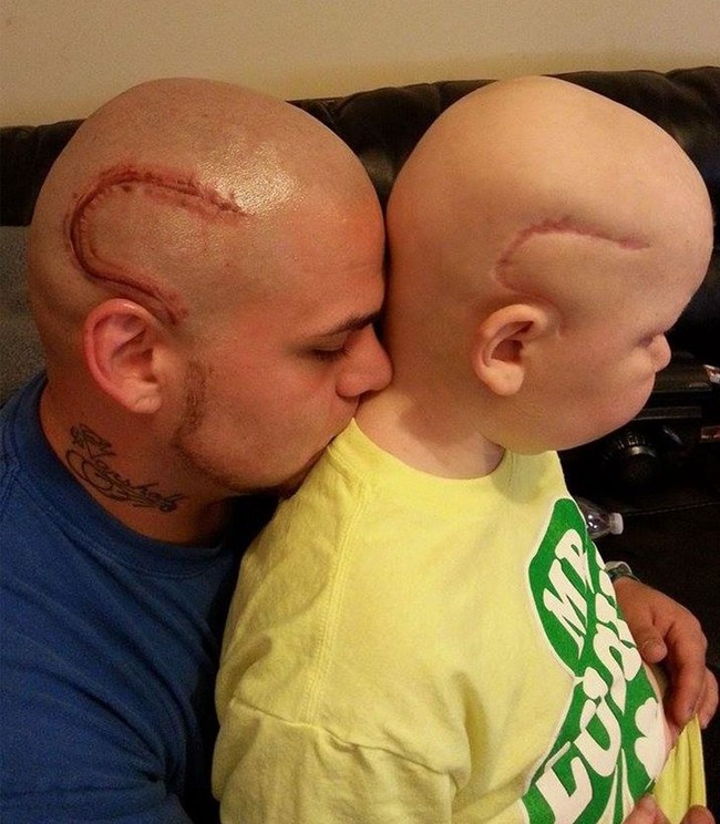 Hati orangtua mana yang tidak luka ketika melihat anaknya jatuh sakit.  Foto ini memperlihatkan seorang ayah dengan tato yang menyerupai bekas luka untuk membangkitkan kepercayaan diri anak yang sedang menderita kanker otak. (Foto: Dok. BrightSide)