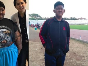 Bobot Sudah Turun Drastis, Kenapa Aria Bocah Tergemuk Harus Operasi Lagi?