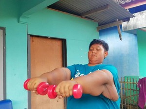 Kerja Keras Tim Dokter Angkat Gelambir Kulit Aria Bocah Tergemuk