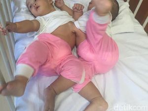 Bayi Kembar Siam Adam-Malik Segera Dioperasi Tim Dokter RSUP Medan