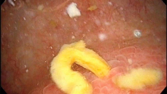 Rekaman video menunjukkan materi feses dari dinding usus wanita bocor ke kandung kemih. (Foto: New England Journal of Medicine) Rekaman video menunjukkan materi feses dari dinding usus wanita bocor ke kandung kemih. (Foto: New England Journal of Medicine)