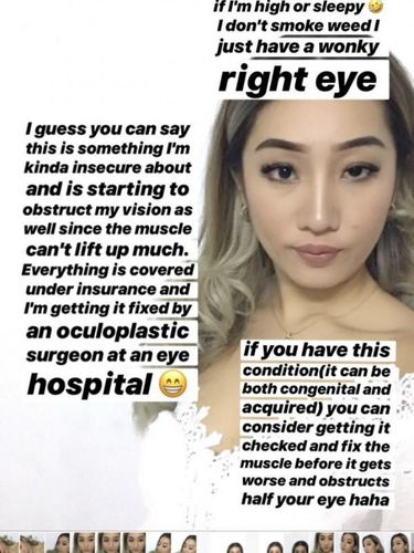 10 Tahun Pakai Lensa Kontak, Kelopak Mata Selebgram Ini Jadi Beda Sebelah