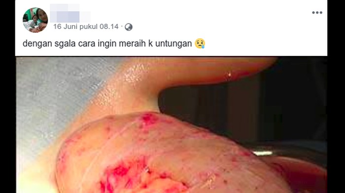 Hoax pencurian ginjal yang kembali ramai di Facebook. Foto: Viral Facebook Hoax pencurian ginjal yang kembali ramai di Facebook. Foto: Viral Facebook