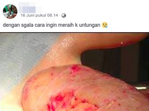 Viral Geng Pencuri Ginjal, Ini Faktanya