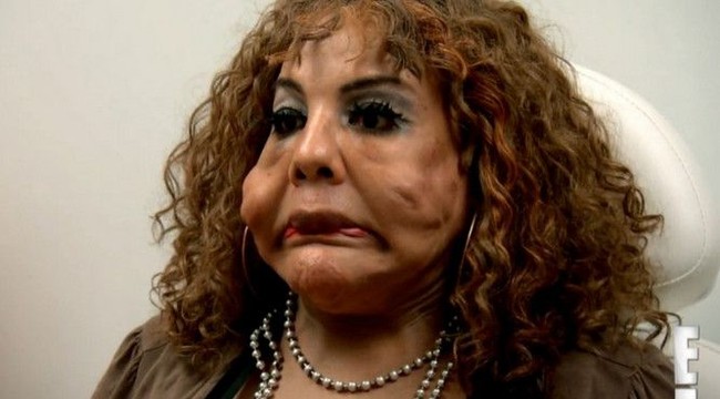 Sejak 2012, transgender 67 tahun itu mencoba melakukan perawatan untuk memudarkan semen yang ada di wajahnya. Namun hasilnya tidak signifikan. Wajahnya masih saja asimetris dengan benjolan-benjolan keras di wajah.  Foto: dok. Instagram, Botched E! Foto: dok. Instagram, Botched E!