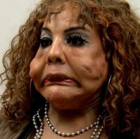 Sejak 2012, transgender 67 tahun itu mencoba melakukan perawatan untuk memudarkan semen yang ada di wajahnya. Namun hasilnya tidak signifikan. Wajahnya masih saja asimetris dengan benjolan-benjolan keras di wajah.  Foto: dok. Instagram, Botched E! Foto: dok. Instagram, Botched E!