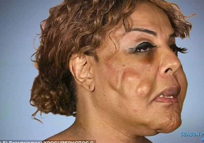 Akibatnya, wajah Rajee menjadi rusak parah. Awalnya dia merasakan bagian dalam kulit wajahnya seperti terbakar hingga terjadinya benjolan-benjolan di wajah. Oleh suntikan semen itu, wajah Rajee pun menjadi asimetris.  Foto: dok. Instagram, Botched E!