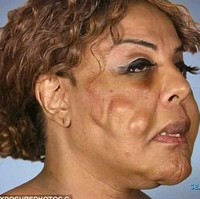 Akibatnya, wajah Rajee menjadi rusak parah. Awalnya dia merasakan bagian dalam kulit wajahnya seperti terbakar hingga terjadinya benjolan-benjolan di wajah. Oleh suntikan semen itu, wajah Rajee pun menjadi asimetris.  Foto: dok. Instagram, Botched E!