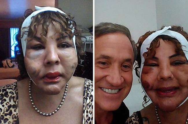 Sampai akhirnya dia mengikuti acara reality show Botched, sebuah acara untuk memperbaiki operasi plastik yang pernah gagal. Sejak 2016, Rajee mendapatkan penanganan intensif dari dua dokter kecantikan Hollywood yang telah populer, Dr. Dubrow dan Dr. Nassif.  Foto: dok. Instagram, Botched E!