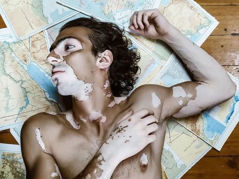 Kisah Hassan yang Dulu Di-bully Karena Kulit Belang, Kini Jadi Model Mendunia