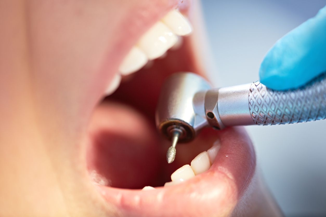 Close-up of human teeth being drilled by dentist
