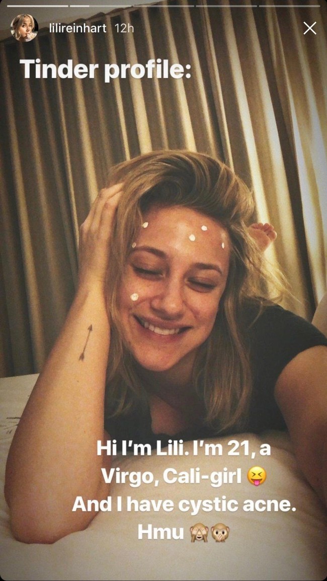 Bintang serial televisi Riverdale, Lili Reinhart, berpose selfie dengan wajah dihiasi obat jerawat. Foto: Instagram
