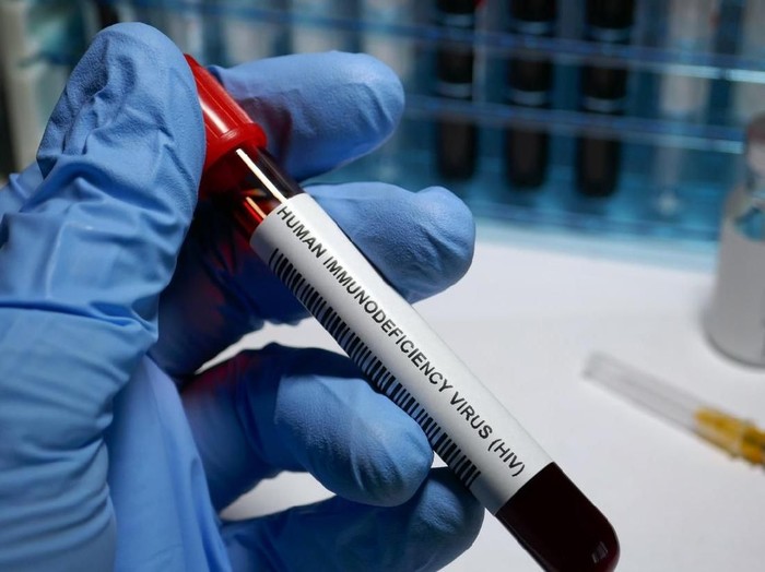 HIV - sexually transmitted disease blood test and treatment