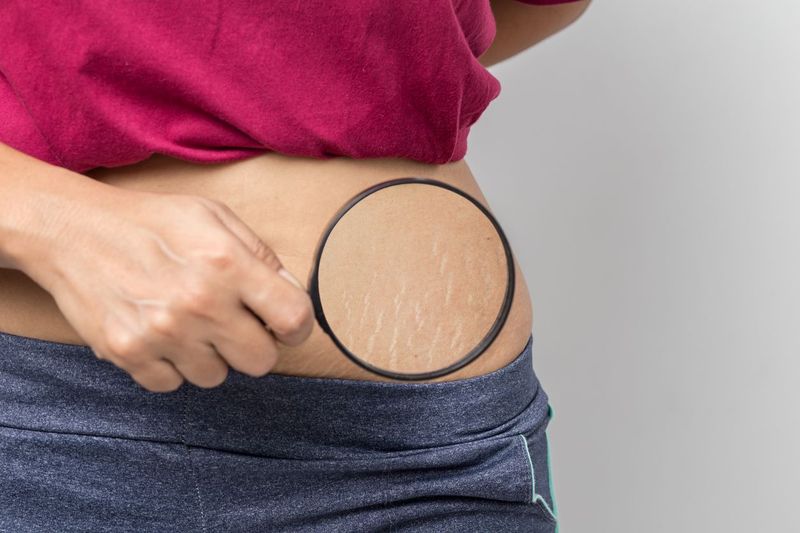 Women Show off the belly after birth. Stretch Marks on white background